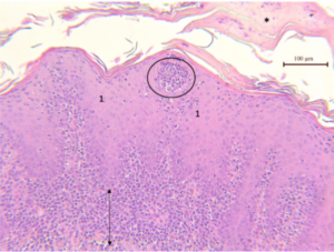 Photo 21 : Acanthose épidermique irrégulière * : Hyperkératose <-------> : Infiltrat lichénoïde riche en plasmocytes O : Pustule intra-épidermique