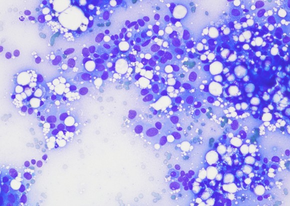 Aspiration à l’aguille fine de sertolinome, coloration MGG. Les cellules exfolient en amas peu cohésifs. Les cellules ont des bordures variablement distinctes, le cytoplasme de basophile modérée contient quelques vacuoles caractéristiques.