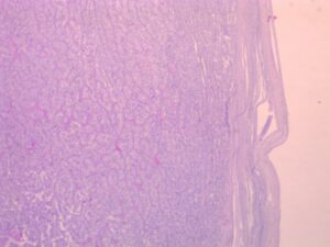 X4 - Prolifération cellulaire dense, entreprenant la totalité du parenchyme testiculaire