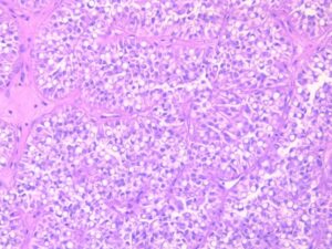 X20 - Lobules tumoraux avec formations pallissadiques périphériques de cellules vacuolisées