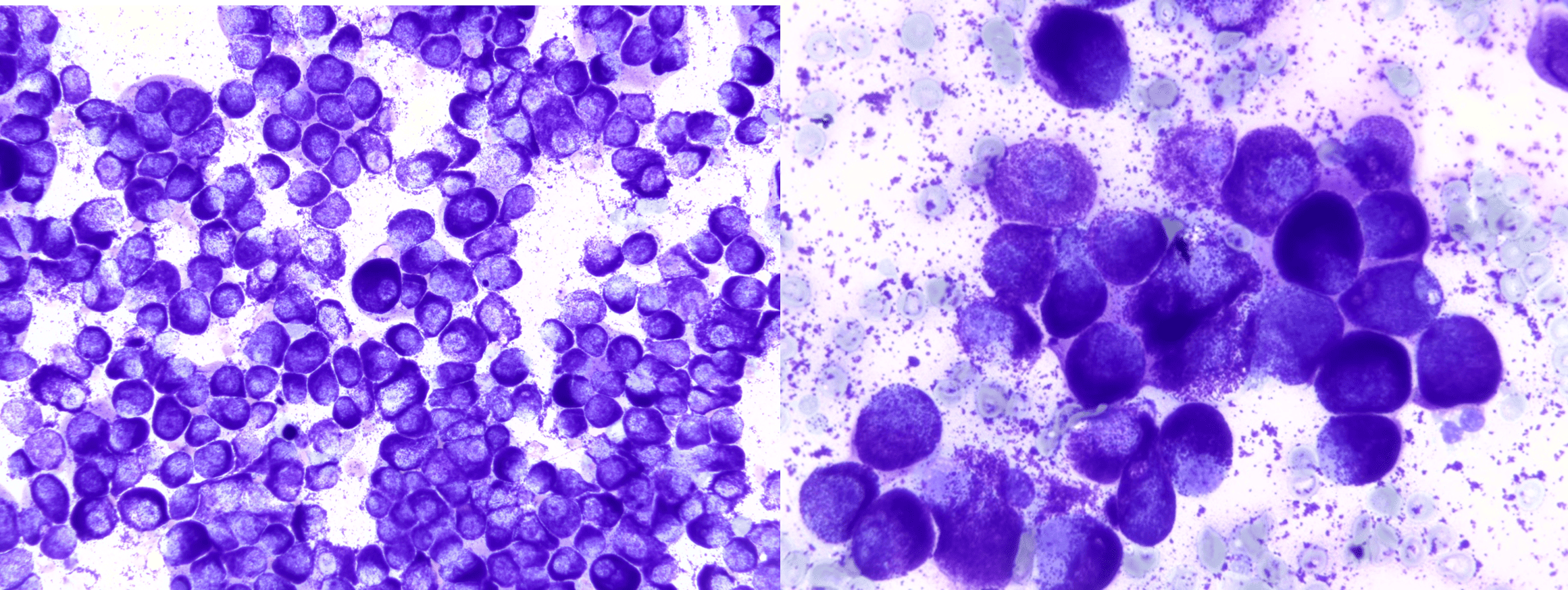 IMAGE 1 - Mastocytome cutané bien granuleux de chien, coloration MGG, Grx500 et x1000.Notez les très nombreuses granulations violettes caractéristiques qui couvrent entièrement le cytoplasme, et partiellement le noyau.