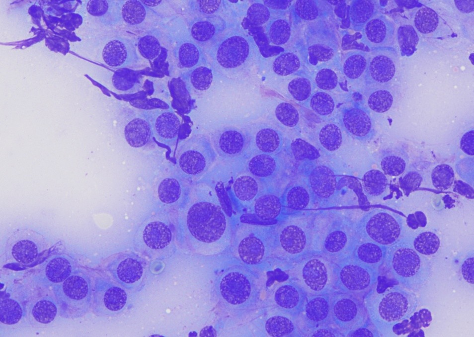 IMAGE 2 - Mastocytome cutané scrotal, non granuleux, de haut grade de malignité cytologique selon Camus, coloration MGG, Grx1000